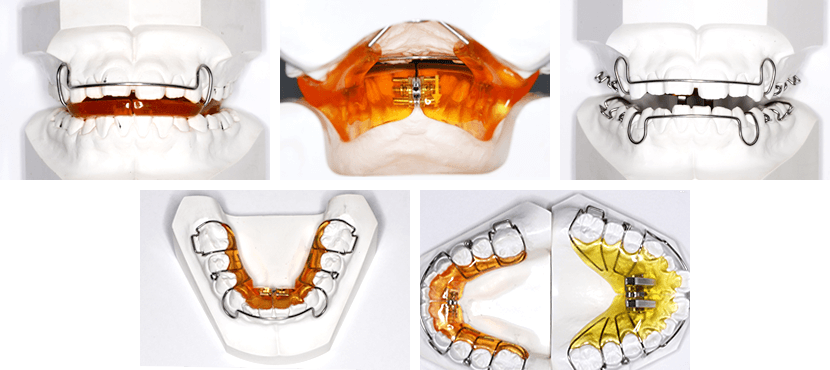 様々な歯列矯正の種類